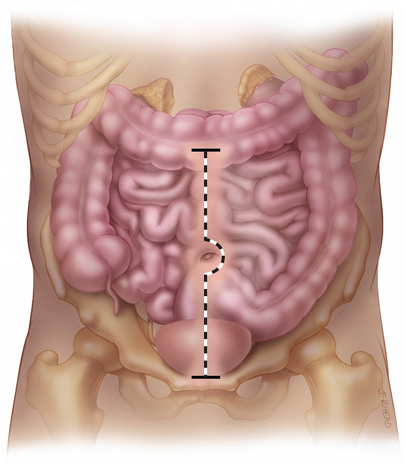 iliocecocystoplasty - incision