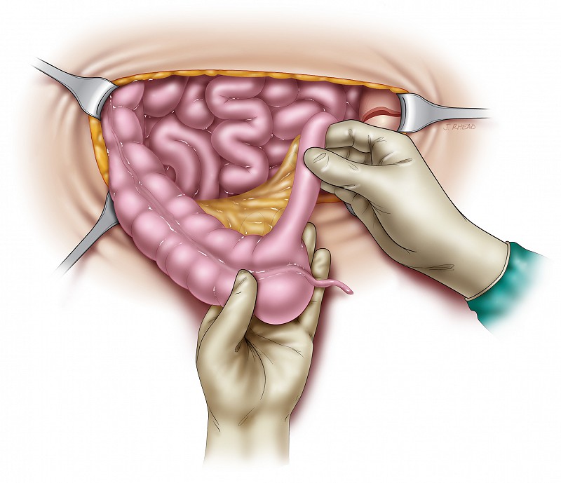 ileocecocystoplasty - isolating cecum