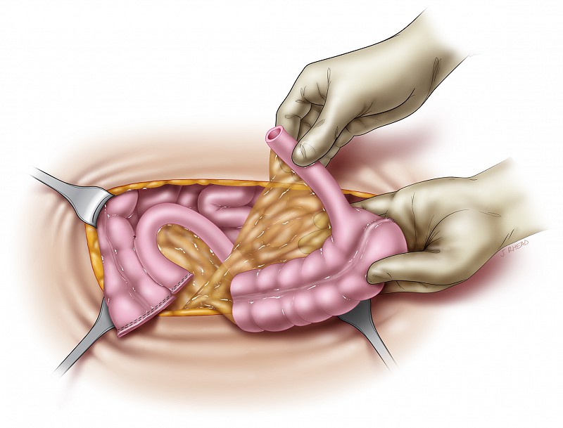ileocecocystoplasty - reanastomosis of ileum and colon
