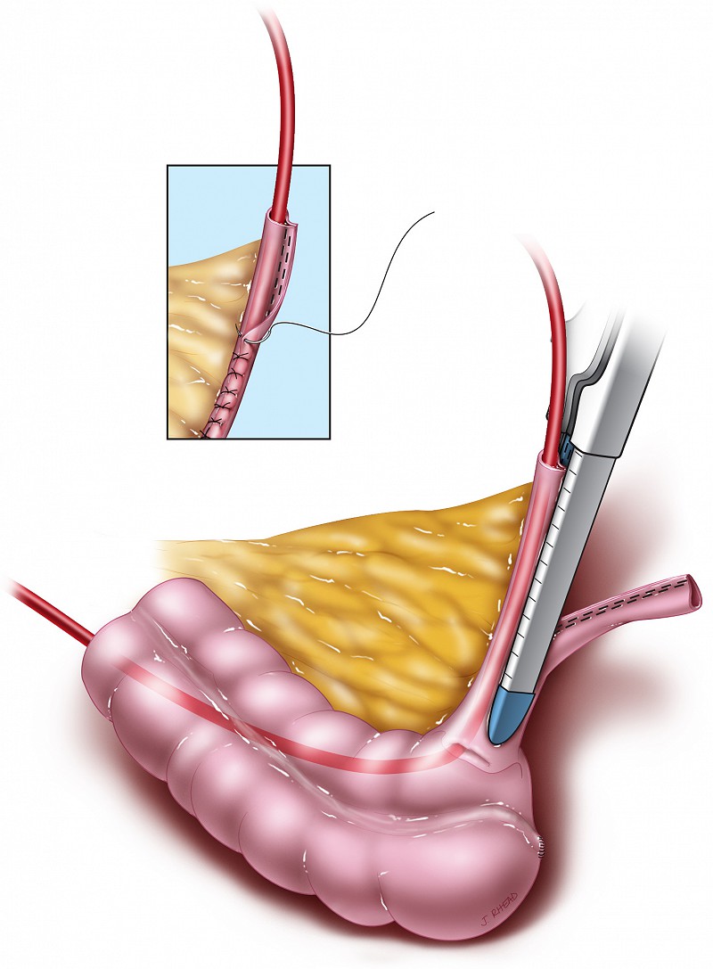 ileocecocystoplasty - imbrication of ileum