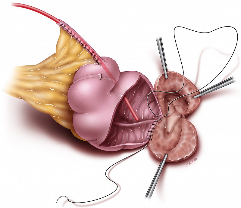 ileocecocystoplasty - bladder anastomosis