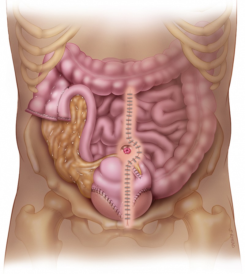 iliocecocystoplasty - stoma
