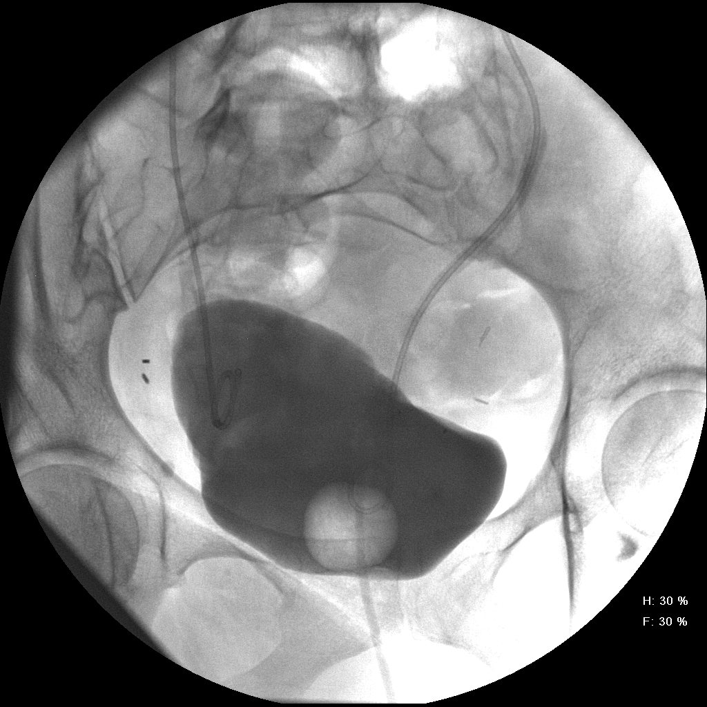 Allen cystogram