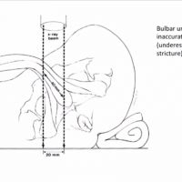 Background About Urethral Strictures