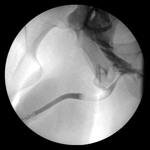 Barwegen RUG injury