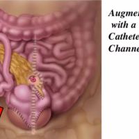 Bladder Augmentation Surgery