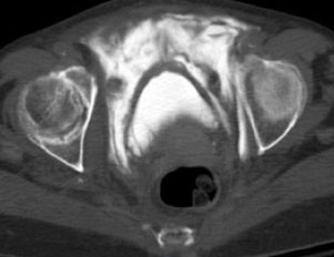 Bladdertrauma