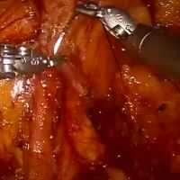 Buccal Mucosa Ureteroplasty and Ureteral Re-Implant Surgery video image
