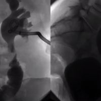 Complications from Radiation Treatment of Gynecologic Cancer image