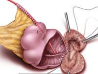 Continent Catheterizable Ileal Cecocystoplasty: University of Utah image thumbnail