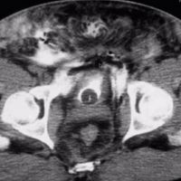 Lower Urinary Tract Trauma - Part 1 Image