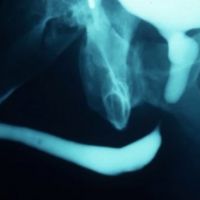 Pelvic Fracture Complications image thumbnail