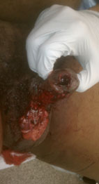 Penile gunwound