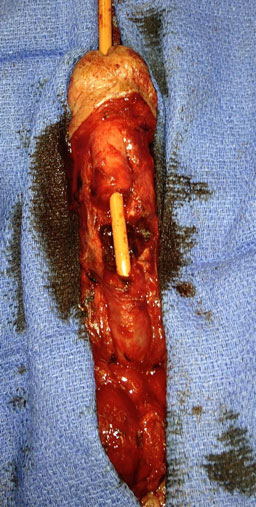 Peniletrauma