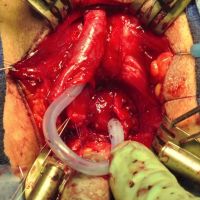 Posterior Urethroplasty for Pelvic Fracture Urethral Injury video image