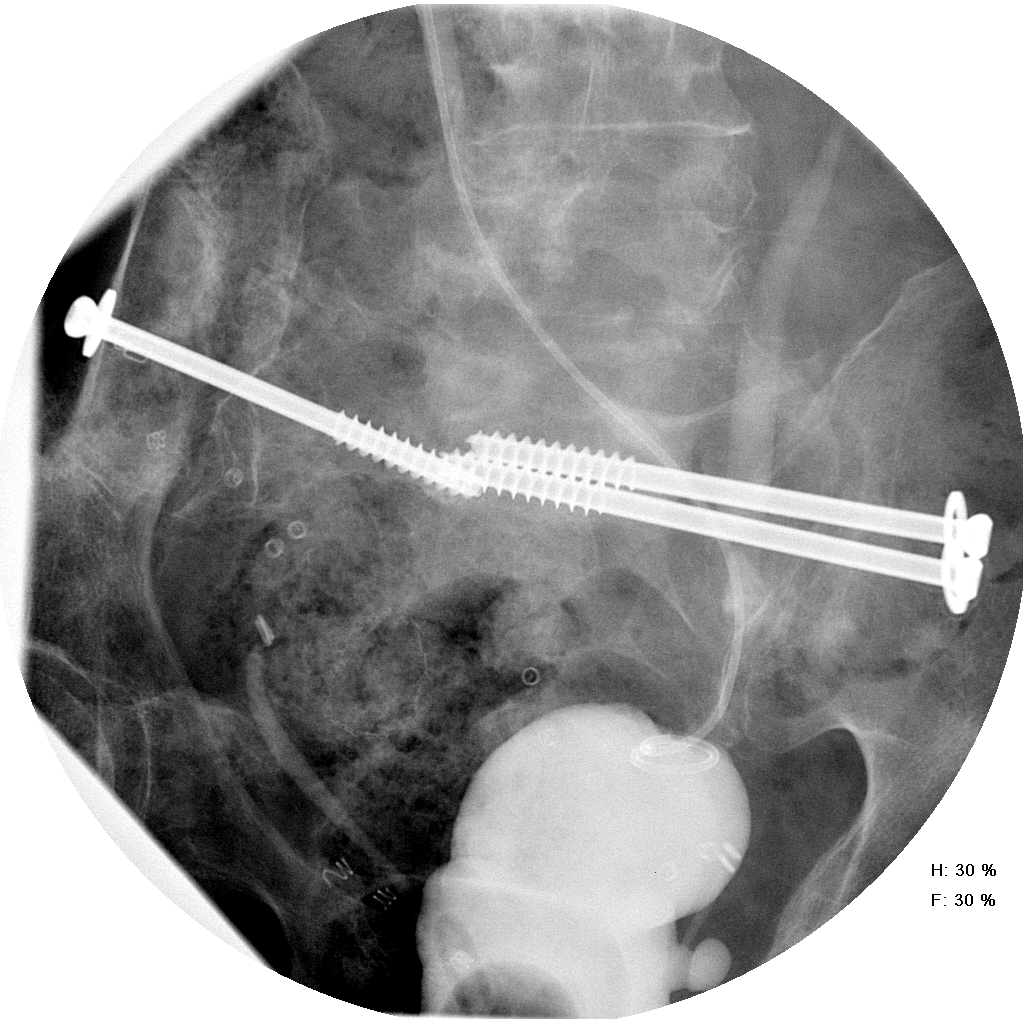 Potash post op cystogram