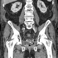 Radiation Injury after Prostate Cancer Treatment, 2017 Image