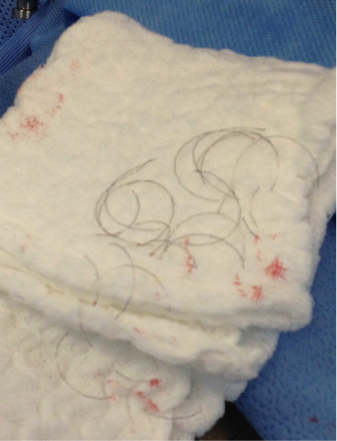 Stent 2