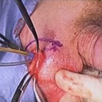 The 30 Minute Artificial Urinary Sphincter Video Image