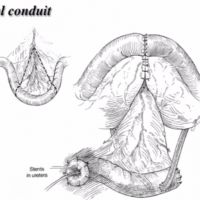Urinary Diversion Surgery image thumbnail
